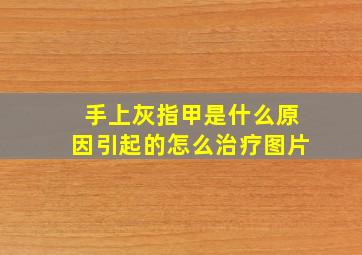 手上灰指甲是什么原因引起的怎么治疗图片