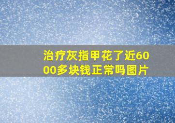 治疗灰指甲花了近6000多块钱正常吗图片