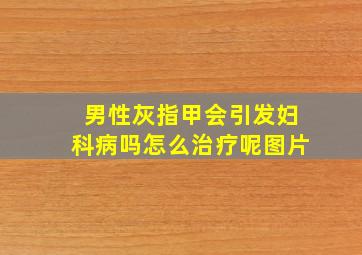 男性灰指甲会引发妇科病吗怎么治疗呢图片